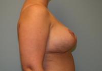 Breast Surgery  Case 106 - Breast Lift