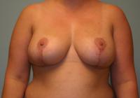 Breast Surgery  Case 106 - Breast Lift