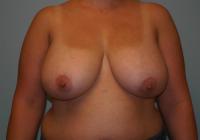 Breast Surgery  Case 106 - Breast Lift