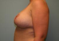 Breast Surgery  Case 106 - Breast Lift