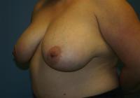 Breast Surgery  Case 107 - Breast Lift