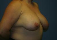 Breast Surgery  Case 107 - Breast Lift