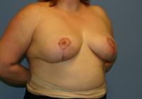 Breast Surgery  Case 107 - Breast Lift