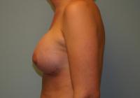 Breast Surgery  Case 108 - Breast Augmentation