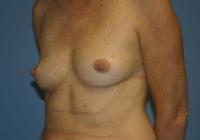 Breast Surgery  Case 110 - Breast Augmentation