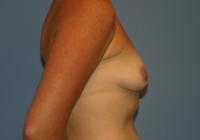 Breast Surgery  Case 111 - Breast Augmentation