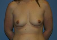 Breast Surgery  Case 112 - Breast Augmentation