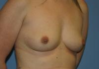 Breast Surgery  Case 112 - Breast Augmentation