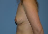 Breast Surgery  Case 112 - Breast Augmentation