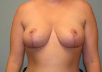 Breast Surgery  Case 121 - Breast Reduction