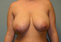 Breast Surgery  Case 121 - Breast Reduction