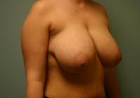 Breast Surgery  Case 121 - Breast Reduction