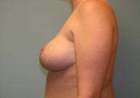 Breast Surgery  Case 121 - Breast Reduction