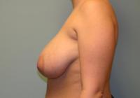Breast Surgery  Case 121 - Breast Reduction