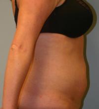 Body Contouring  Case 131 - Tummy Tuck