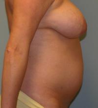 Body Contouring  Case 131 - Tummy Tuck