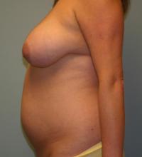 Body Contouring  Case 131 - Tummy Tuck