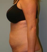 Body Contouring  Case 131 - Tummy Tuck