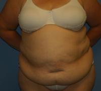 Body Contouring  Case 141 - Tummy Tuck