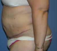 Body Contouring  Case 141 - Tummy Tuck