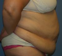 Body Contouring  Case 141 - Tummy Tuck