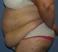 Body Contouring  Case 141 - Tummy Tuck