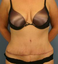 Body Contouring  Case 151 - Tummy Tuck