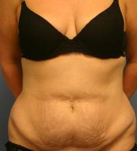 Body Contouring  Case 151 - Tummy Tuck