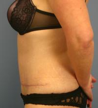 Body Contouring  Case 151 - Tummy Tuck