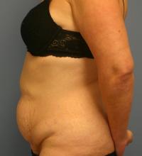 Body Contouring  Case 151 - Tummy Tuck