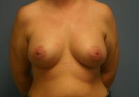 Breast Surgery  Case 161 - Breast Augmentation