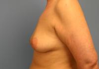 Breast Surgery  Case 161 - Breast Augmentation