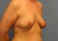 Breast Surgery  Case 161 - Breast Augmentation