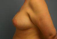 Breast Surgery  Case 161 - Breast Augmentation