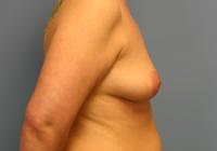 Breast Surgery  Case 161 - Breast Augmentation