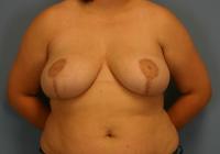 Breast Surgery  Case 171 - Breast Reduction