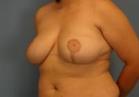 Breast Surgery  Case 171 - Breast Reduction