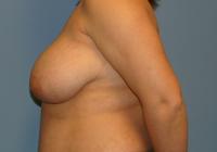 Breast Surgery  Case 171 - Breast Reduction