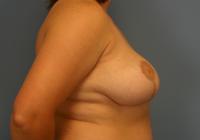 Breast Surgery  Case 171 - Breast Reduction