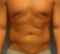 Body Contouring  Case 181 - Liposuction