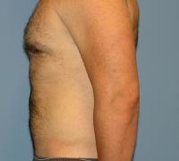 Body Contouring  Case 181 - Liposuction