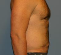 Body Contouring  Case 181 - Liposuction