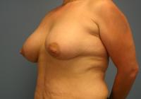 Breast Surgery  Case 191 - Breast Lift with Augmentation