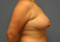 Breast Surgery  Case 191 - Breast Lift with Augmentation