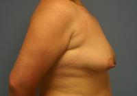 Breast Surgery  Case 191 - Breast Lift with Augmentation