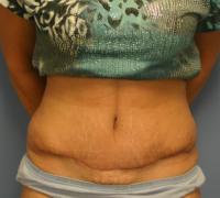 Body Contouring  Case 201 - Tummy Tuck