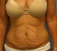 Body Contouring  Case 201 - Tummy Tuck