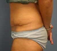 Body Contouring  Case 201 - Tummy Tuck