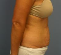 Body Contouring  Case 201 - Tummy Tuck