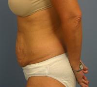 Body Contouring  Case 201 - Tummy Tuck